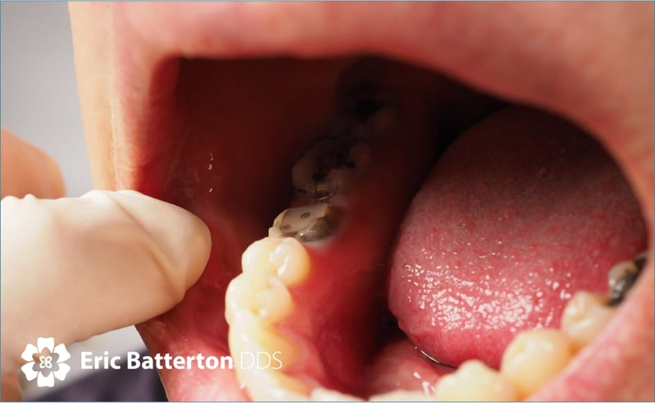 A close-up view of an open mouth showing a cavity on one of the teeth, highlighting tooth decay and the need for dental care.