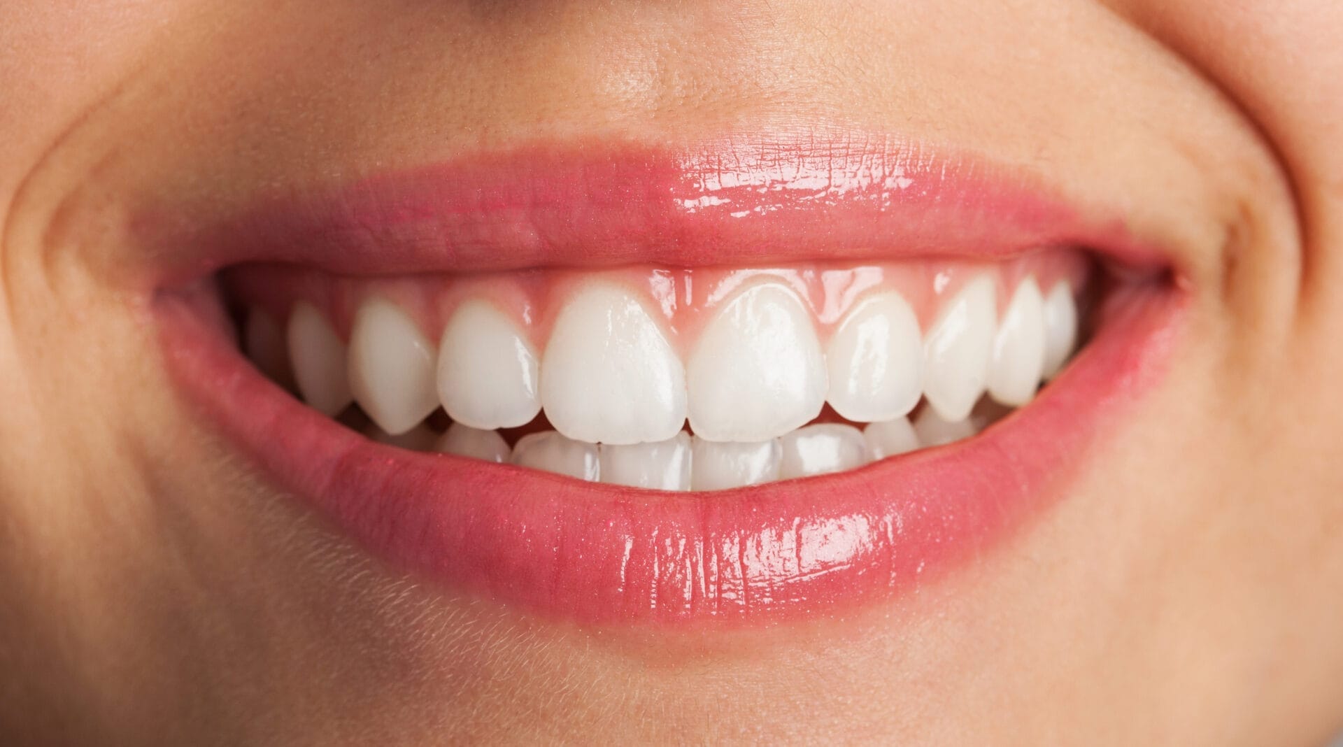 Close-up of a perfect white smile after professional teeth whitening treatment
